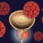 Prostate cancer treatment in Torrevieja