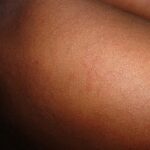 Measles warning