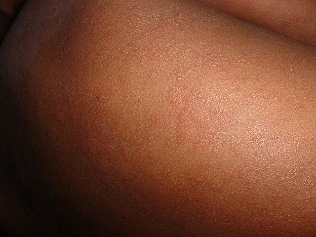 Measles warning