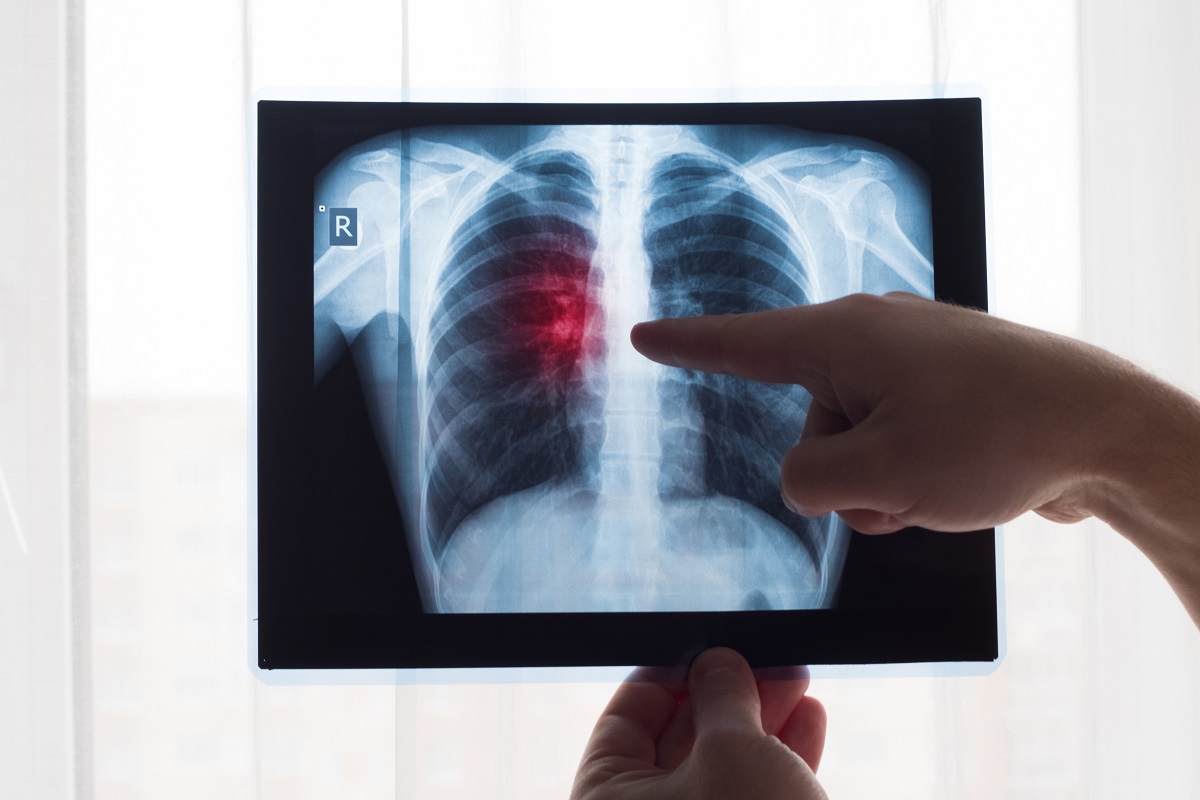 Cancer care at Quironsalud Torrevieja