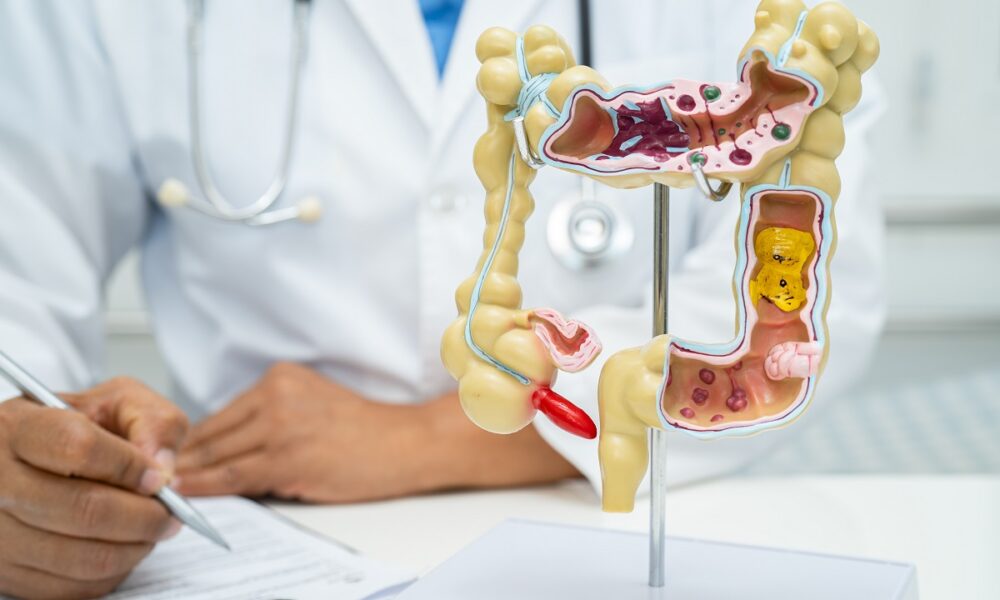 An accurate diagnosis: the key to properly treating Irritable Bowel Syndrome and SIBO Intestine, appendix and digestive system, doctor holding anatomy model for study diagnosis and treatment in hospital.